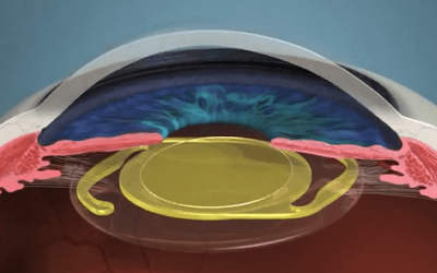 Cirurgia de Catarata – Lente Intra-Ocular
